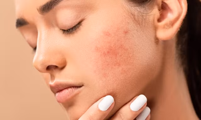 Sau khi hết mụn, nhiều người Việt vẫn mắc 5 sai lầm khiến mụn quay trở lại 