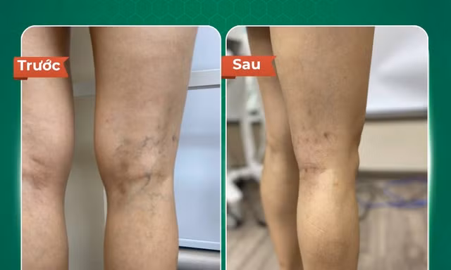 Dr.Vein giải pháp điều trị suy giãn tĩnh mạch bằng gây xơ tĩnh mạch 