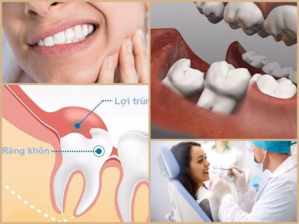 Đau răng khôn: Những điều quan trọng bạn cần biết