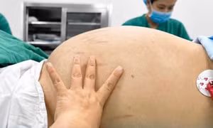 Tưởng bụng lớn do tăng cân đơn thuần, tá hỏa khi biết mình bị u buồng trứng 