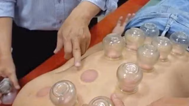 Đột quỵ nặng khi nhờ chị gái giác hơi