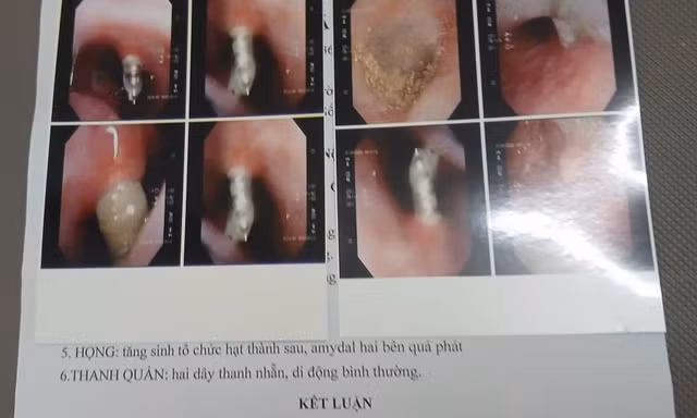 Bệnh nhân N.C.K bị 4 chiếc đinh vít nong hàm chọc thẳng lên mũi. Ảnh: NVCC.